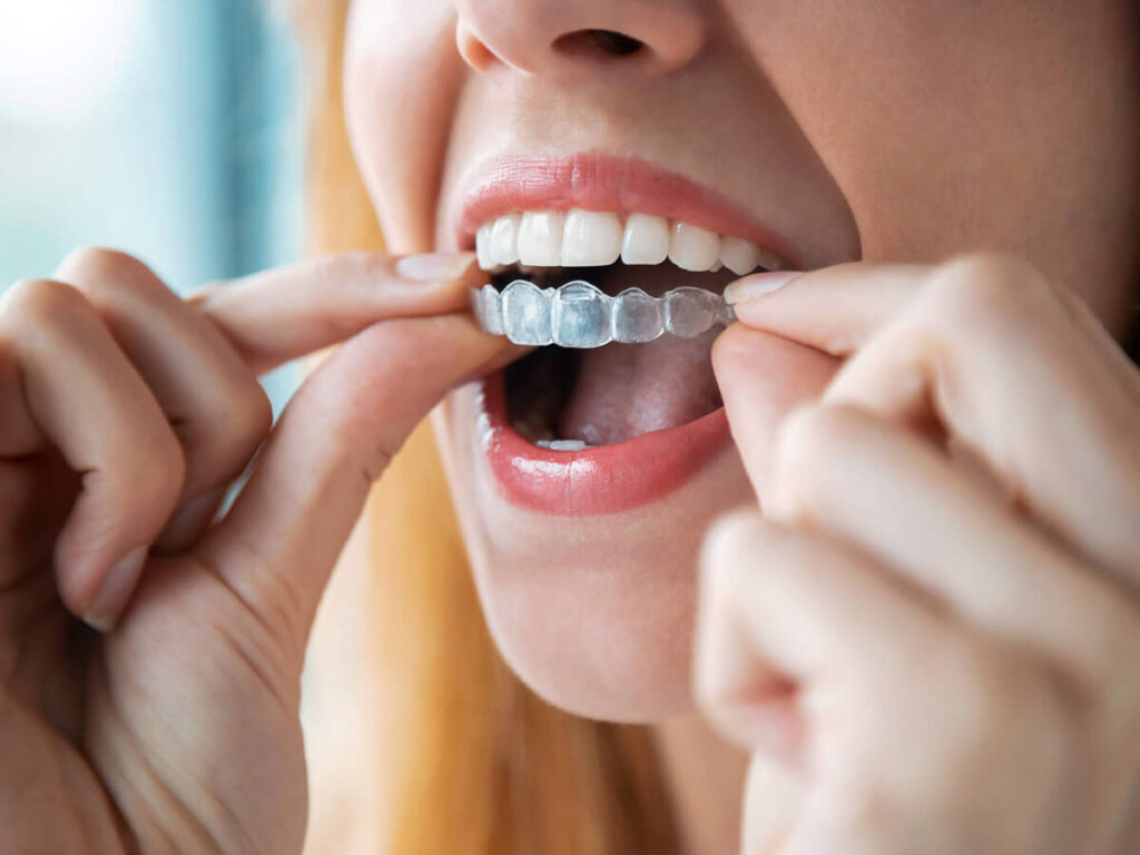 Close-up of a smiling woman inserting a clear orthodontic aligner onto her upper teeth, focusing on the transparent aligner and her hands as she adjusts it, with visible white teeth and pink lipstick.