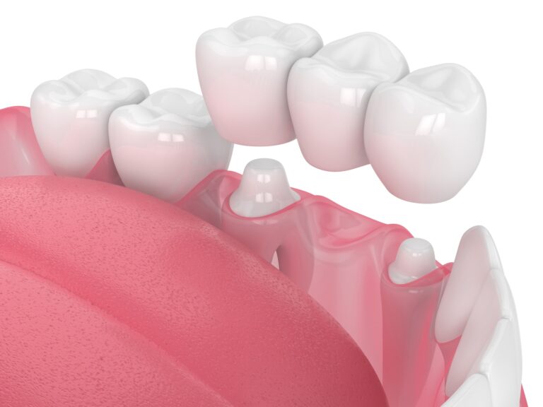 3D-rendered illustration of a dental bridge being placed over prepared teeth. The image shows a row of artificial teeth supported by two dental crowns on adjacent natural teeth, demonstrating the process of replacing missing teeth with a fixed dental bridge.