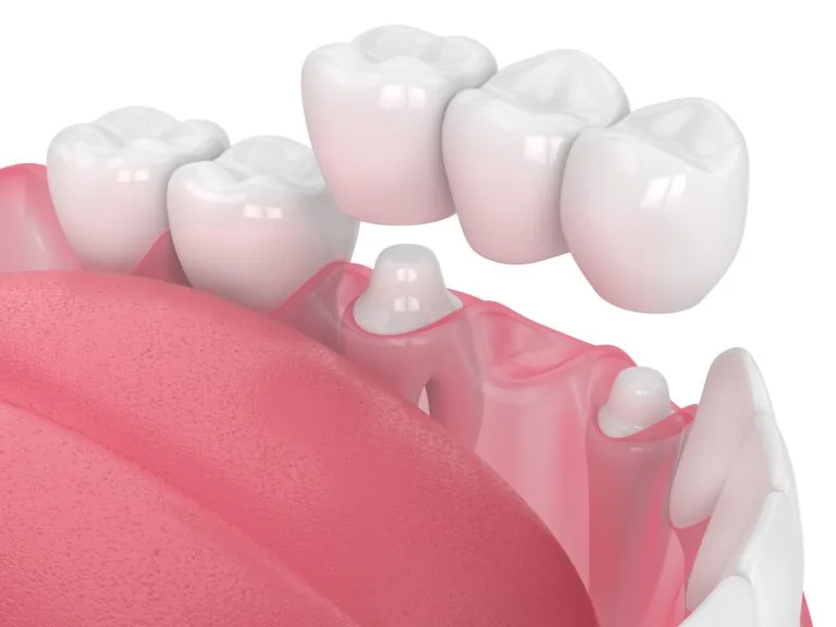 3D-rendered illustration of a dental bridge being placed over prepared teeth. The image shows a row of artificial teeth supported by two dental crowns on adjacent natural teeth, demonstrating the process of replacing missing teeth with a fixed dental bridge.